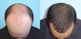 Hair Loss Before And After