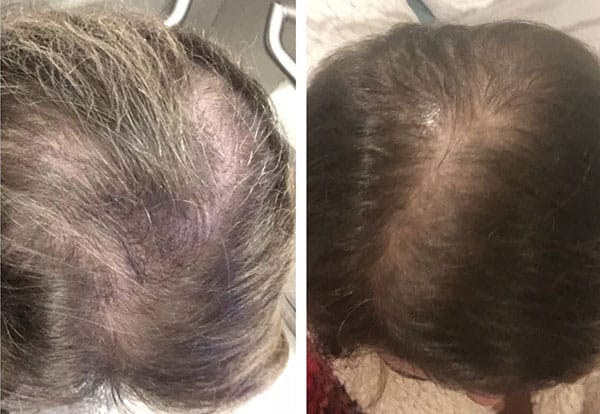 Natural Remedies For Hair Growth